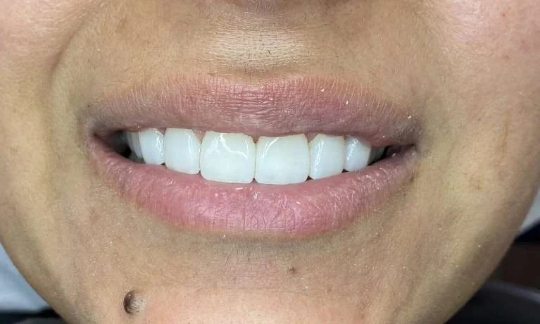 After: the same smile with the gaps closed by crowns on the front teeth.