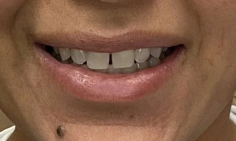 Before: a smile with gaps between the upper front teeth.