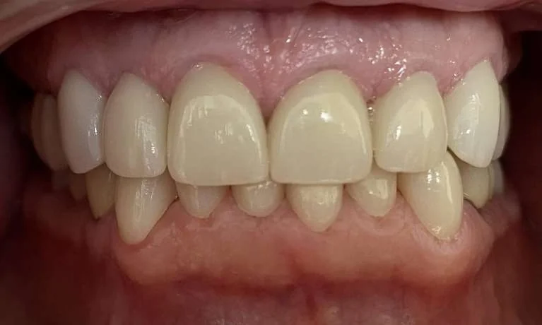 After: new, even crowns across the upper and lower front teeth.