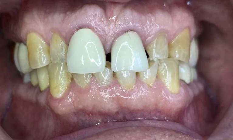 Before: worn, discolored front teeth with two older crowns and a gap between them.