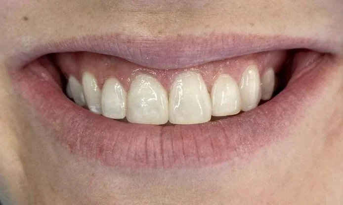 After: the gaps closed with tooth-colored bonding.